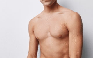 Gynecomastia