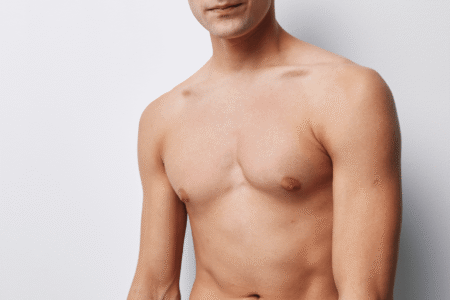 Gynecomastia