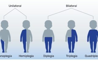 Types of Cerebral Palsy