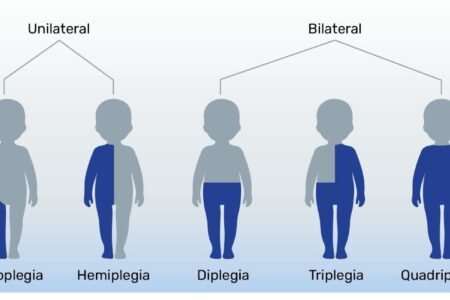 Types of Cerebral Palsy